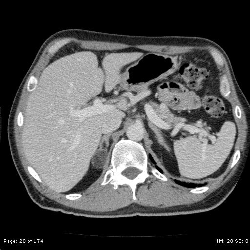 File:Adrenal myelolipoma (Radiopaedia 23636-23764 B 1).jpg