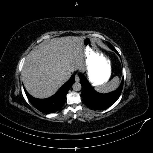 Adrenal myelolipoma (Radiopaedia 84319-99617 Axial With oral contrast 33).jpg