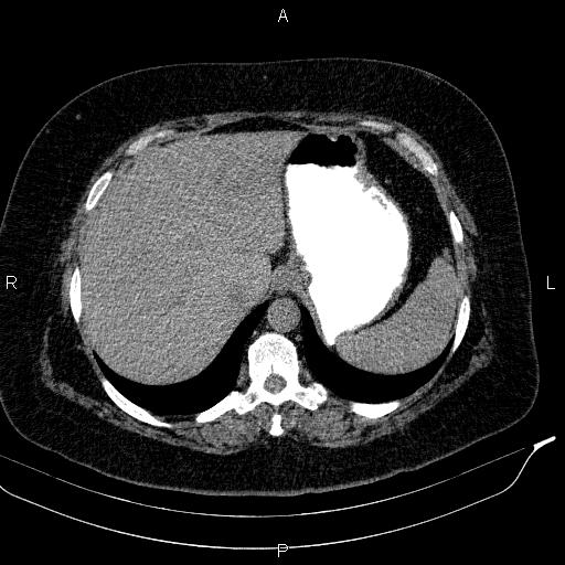 Adrenal myelolipoma (Radiopaedia 84319-99617 Axial With oral contrast 42).jpg