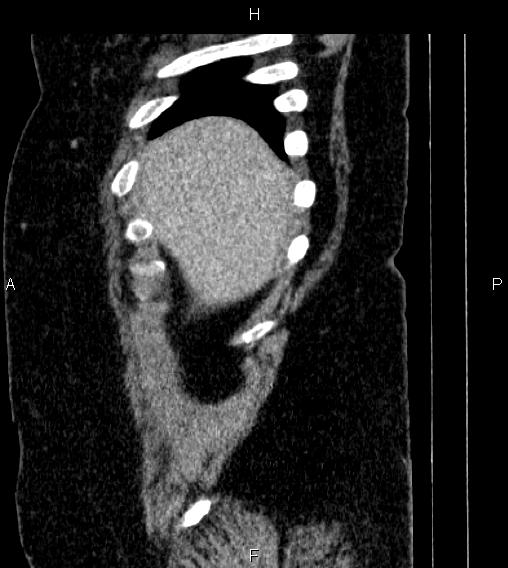 File:Adrenal myelolipoma (Radiopaedia 84319-99617 Sagittal renal cortical phase 6).jpg