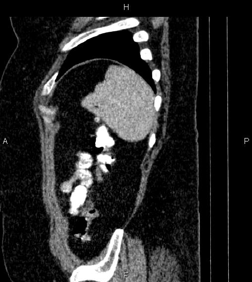 Adrenal myelolipoma (Radiopaedia 84319-99617 Sagittal renal cortical phase 86).jpg