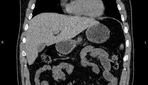 Adrenal myelolipoma (Radiopaedia 84321-99619 Coronal non-contrast 25).jpg
