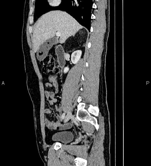 Adrenal myelolipoma (Radiopaedia 87794-104246 Sagittal renal cortical phase 34).jpg