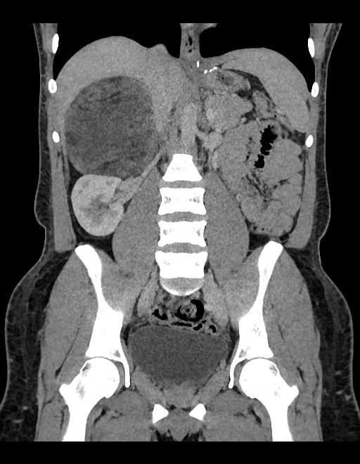 Adrenal myelolipoma - bilateral (Radiopaedia 74805-85810 Coronal C+ portal venous phase 142).jpg