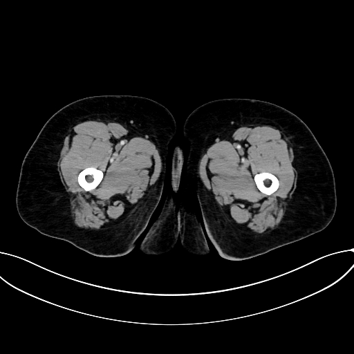 Adrenocortical carcinoma (Radiopaedia 87281-103569 Axial C+ portal venous phase 100).jpg