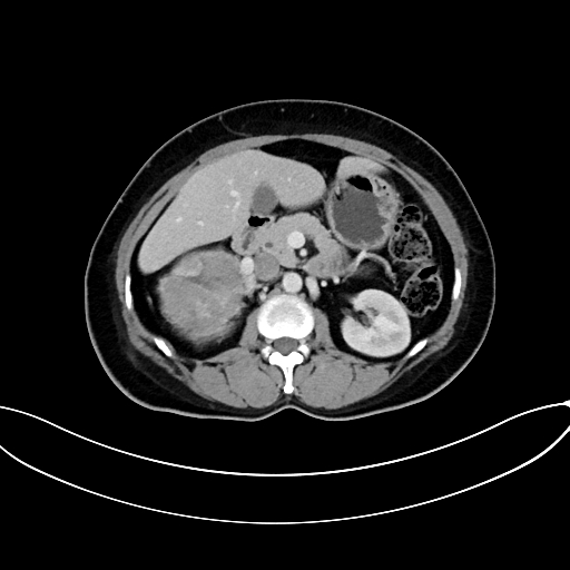 Adrenocortical carcinoma (Radiopaedia 87281-103569 Axial C+ portal venous phase 36).jpg