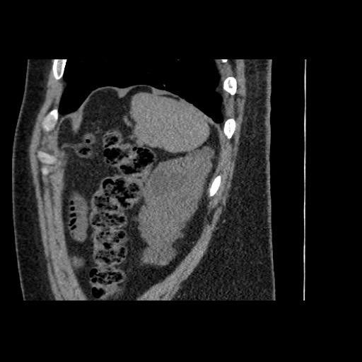 Adult polycystic kidney disease (Radiopaedia 59075-66368 Sagittal non-contrast 81).jpg