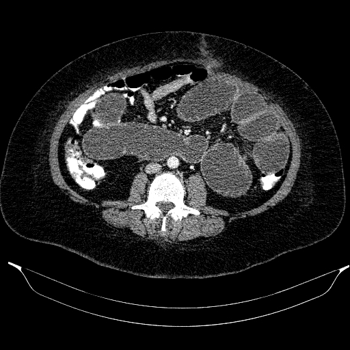 Afferent loop syndrome - secondary to incarcerated trocar site hernia (Radiopaedia 82959-97305 Axial C+ portal venous phase 128).jpg