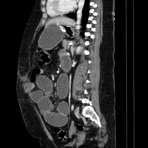 Afferent loop syndrome - secondary to incarcerated trocar site hernia (Radiopaedia 82959-97305 Sagittal C+ portal venous phase 64).jpg
