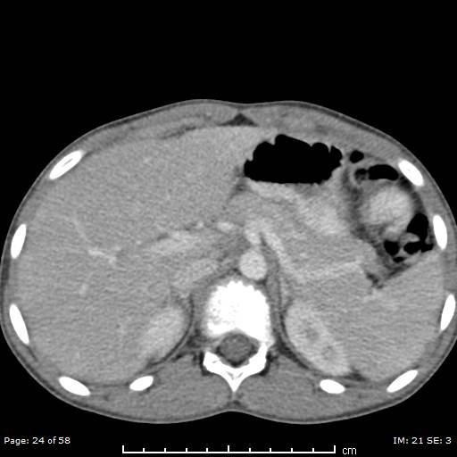 Agenesis of the gallbladder (Radiopaedia 55454-61905 B 24).jpg