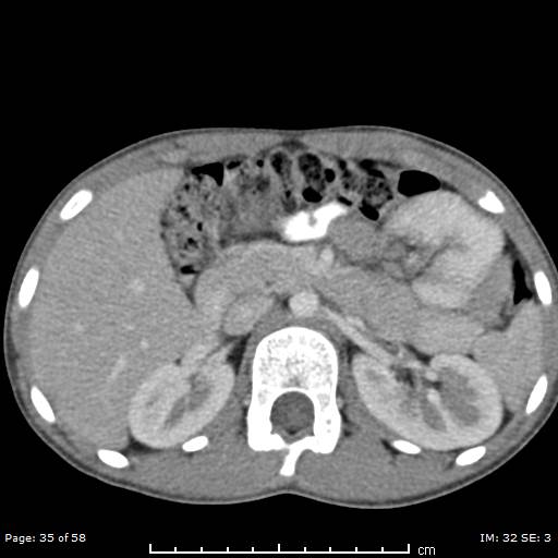 File:Agenesis of the gallbladder (Radiopaedia 55454-61905 B 35).jpg