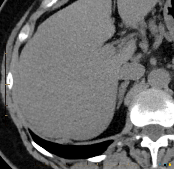 Aggressive angiomyolipoma (Radiopaedia 55765-62328 Axial non-contrast 13).jpg