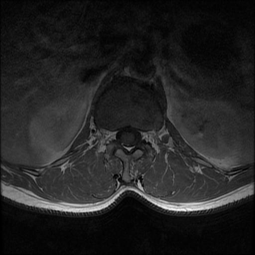 File:Aggressive vertebral hemangioma with pathological fracture (Radiopaedia 69528-79411 Axial T1 C+ 15).jpg