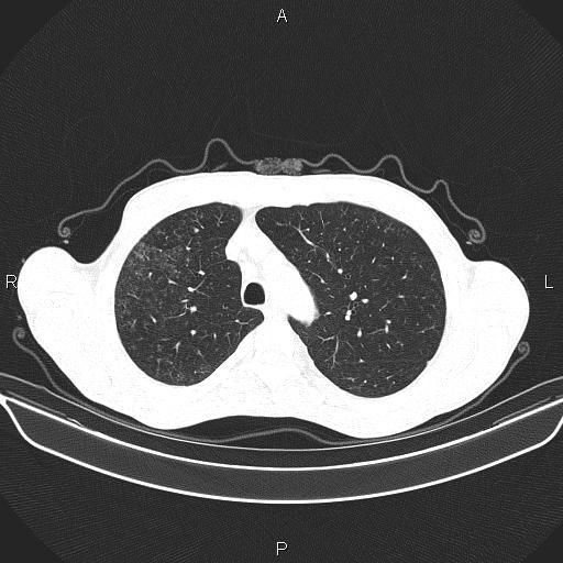 Air bronchogram in pneumonia (Radiopaedia 85719-101512 Axial lung window 18).jpg
