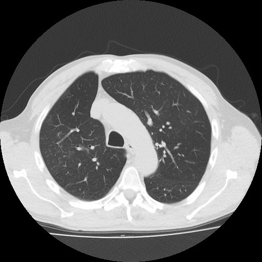 Allergic bronchopulmonary aspergillosis (ABPA) (Radiopaedia 60594-68313 Axial lung window 17).jpg