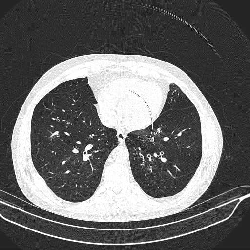 File:Allergic bronchopulmonary aspergillosis (Radiopaedia 21386-21320 Axial lung window 27).jpg