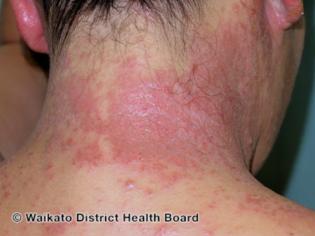 File:Allergic contact dermatitis to hair dye (DermNet NZ contact-dermatitis-025).jpg