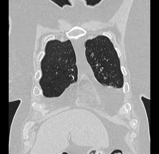 Alpha-1-antitrypsin deficiency (Radiopaedia 72058-82557 Coronal lung window 1).jpg