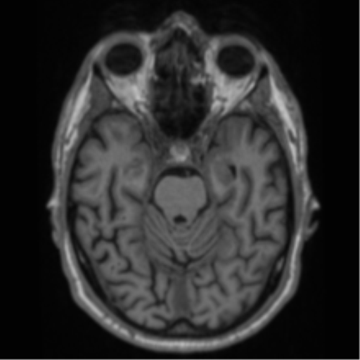 Alzheimer's disease- with Gerstmann syndrome and dressing apraxia (Radiopaedia 54882-61150 Axial T1 25).png