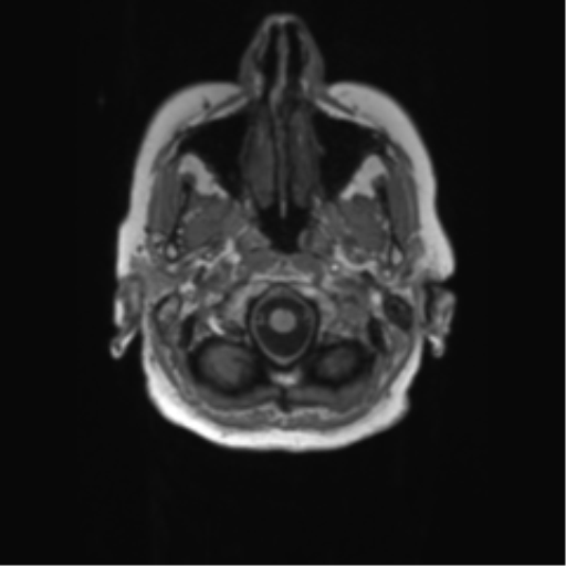 File:Alzheimer's disease (Radiopaedia 42658-45802 Axial T1 140).png