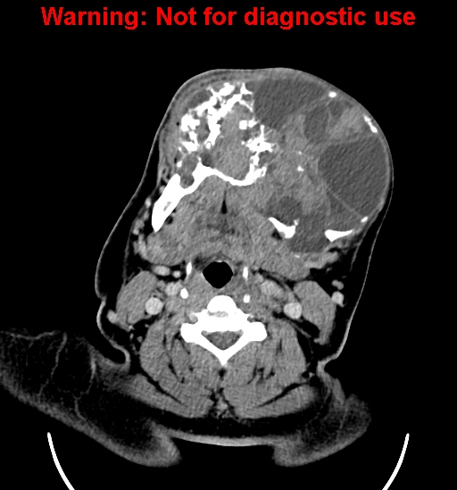 File:Ameloblastoma (Radiopaedia 33126-34164 B 15).jpg