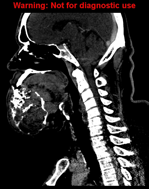 Ameloblastoma (Radiopaedia 33126-34164 F 38).jpg