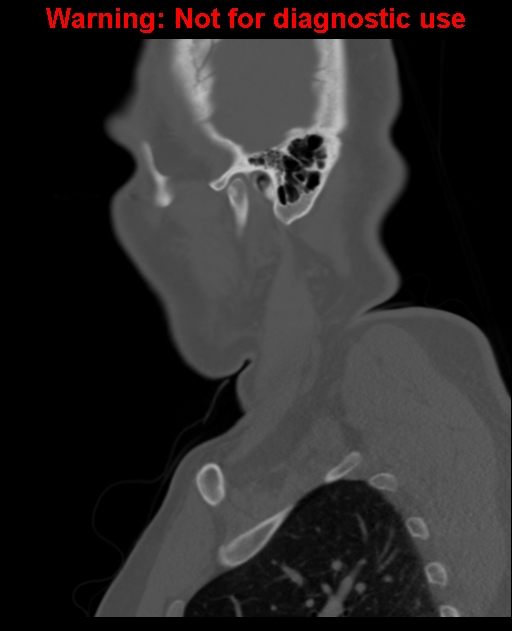 Ameloblastoma (Radiopaedia 33126-34164 Sagittal bone window 60).jpg
