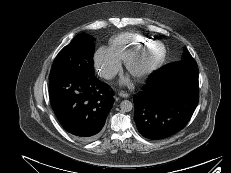 Amiodarone lung (Radiopaedia 62514-70769 Axial non-contrast 62).jpg