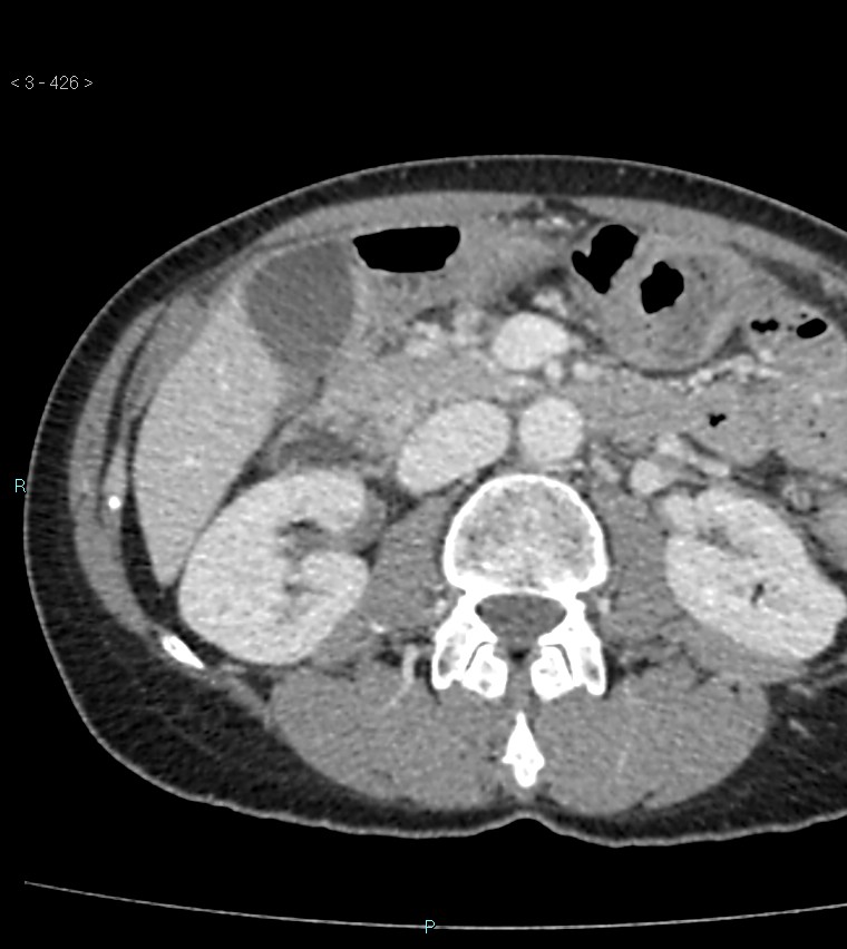 Ampulla of Vater metastasis (Radiopaedia 27820-28065 A 30).jpg