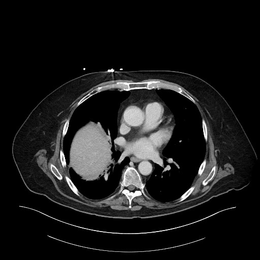 Ampullary adenocarcinoma (Radiopaedia 59373-66734 C 8).jpg