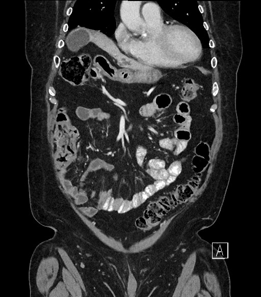 Ampullary adenocarcinoma (Radiopaedia 59373-66734 D 24).jpg