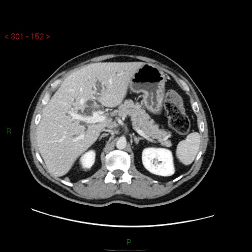 Ampullary carcinoma (Radiopaedia 56396-63056 C 29).jpg