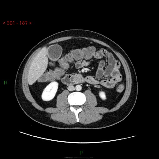 Ampullary carcinoma (Radiopaedia 56396-63056 C 52).jpg