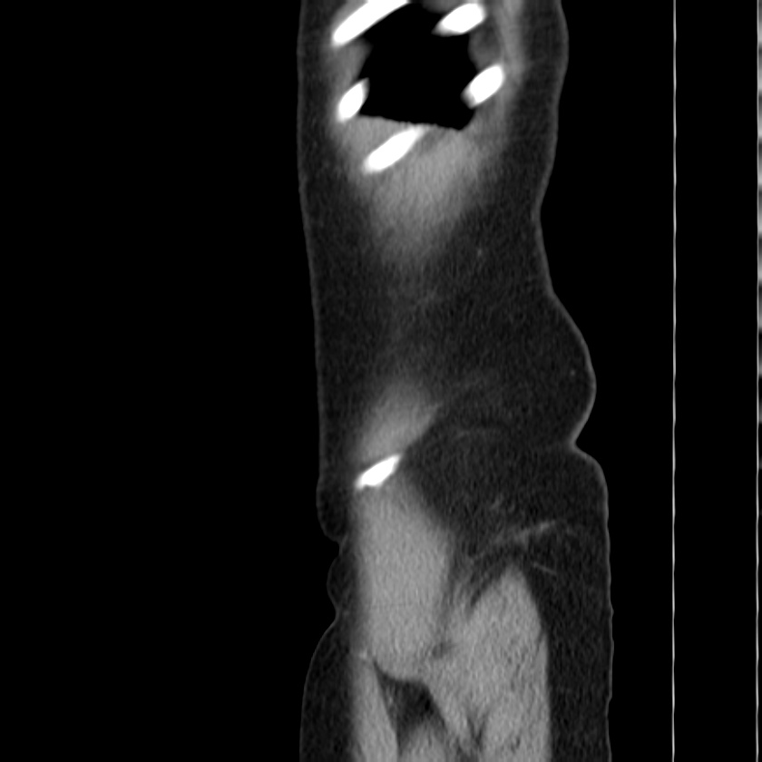 Ampullary tumor (Radiopaedia 22787-22816 D 54).jpg