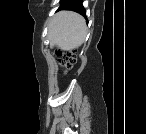 File:Ampullary tumor (Radiopaedia 60333-67998 C 4).jpg