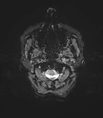 File:Anaplastic astrocytoma (Radiopaedia 86943-103160 Axial SWI 3).png