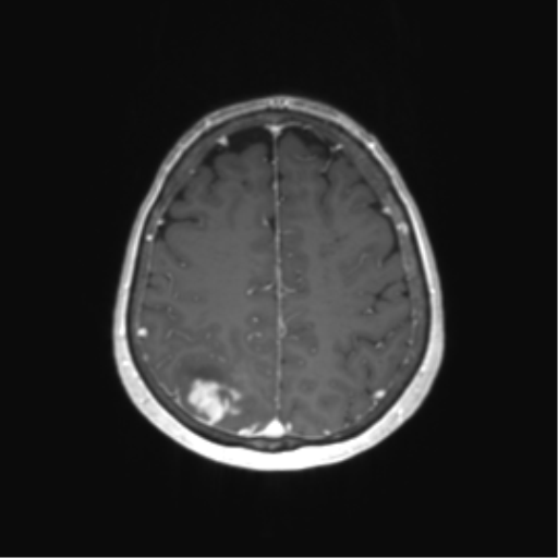 File:Anaplastic astrocytoma (Radiopaedia 86943-103160 Axial T1 C+ 61).png