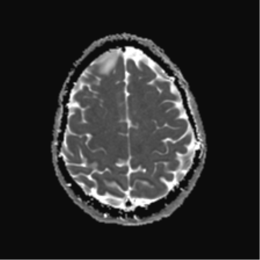 File:Anaplastic astrocytoma IDH mutant (Radiopaedia 50046-55341 Axial ADC 22).png