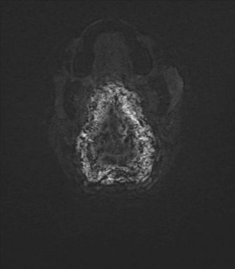 File:Anaplastic astrocytoma IDH mutant (Radiopaedia 50046-55341 Axial SWI 88).png