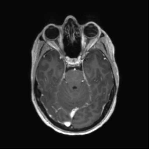 File:Anaplastic astrocytoma IDH mutant (Radiopaedia 50046-55341 Axial T1 C+ 18).png