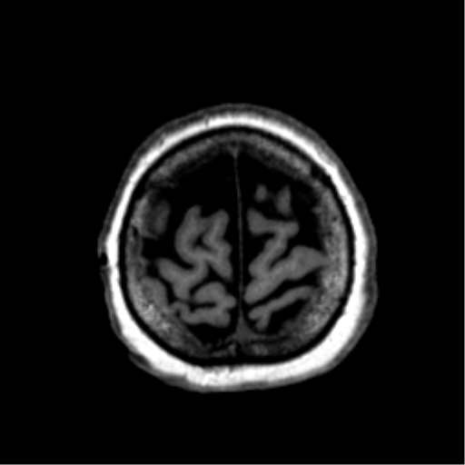 Anaplastic astrocytoma IDH wild-type (pseudoprogression) (Radiopaedia 42209-45277 Axial T1 119).png