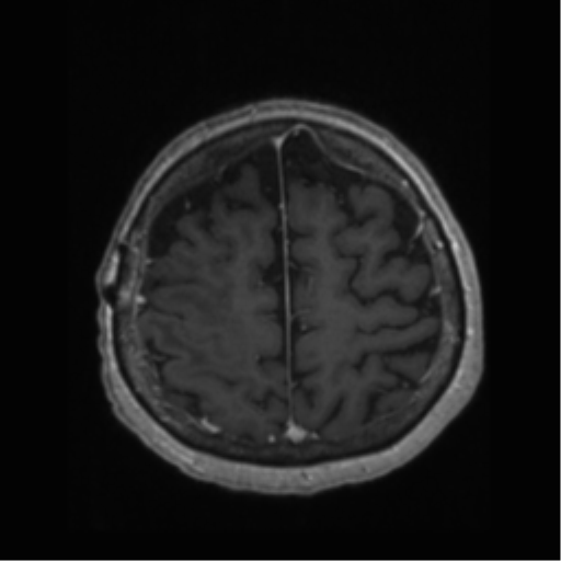File:Anaplastic astrocytoma IDH wild-type (pseudoprogression) (Radiopaedia 42209-45277 Axial T1 C+ 101).png