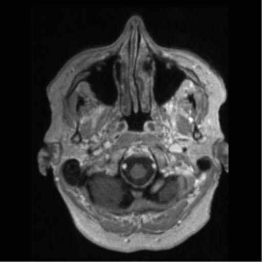 File:Anaplastic astrocytoma IDH wild-type (pseudoprogression) (Radiopaedia 42209-45277 Axial T1 C+ 5).png