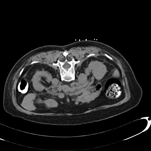 File:Anaplastic lymphoma - with CT biopsy (Radiopaedia 21643-21602 Axial non-contrast 24).jpg