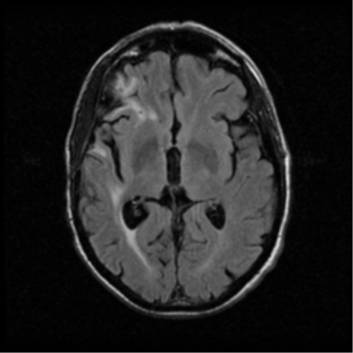 File:Anaplastic meningioma with recurrence (Radiopaedia 34452-35789 Axial FLAIR 12).png