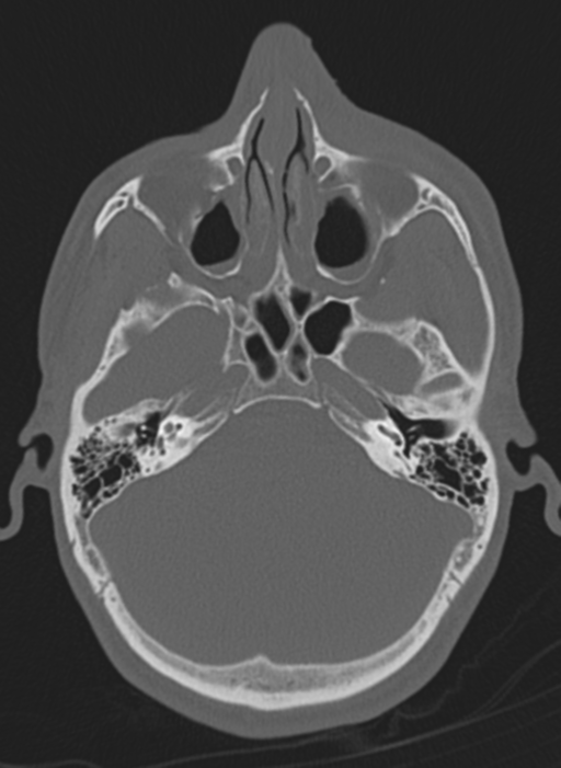 Anaplastic oligodendroglioma with skull fracture (Radiopaedia 74831-85846 Axial bone window 60).png