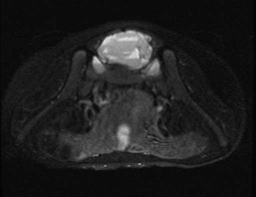 File:Aneurysmal bone cyst - sacrum (Radiopaedia 65190-74196 Axial T2 fat sat 8).jpg