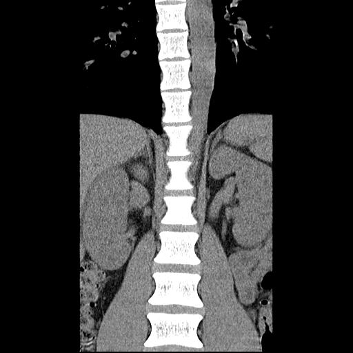 File:Aneurysmal bone cyst T11 (Radiopaedia 29294-29721 Axial non-contrast 1).jpg