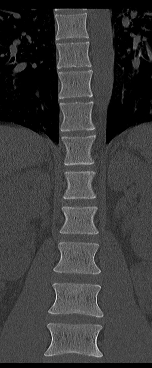 Aneurysmal bone cyst T11 (Radiopaedia 29294-29721 Coronal bone window 20).jpg