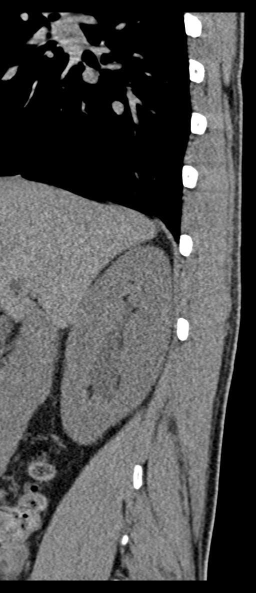 Aneurysmal bone cyst T11 (Radiopaedia 29294-29721 E 75).jpg